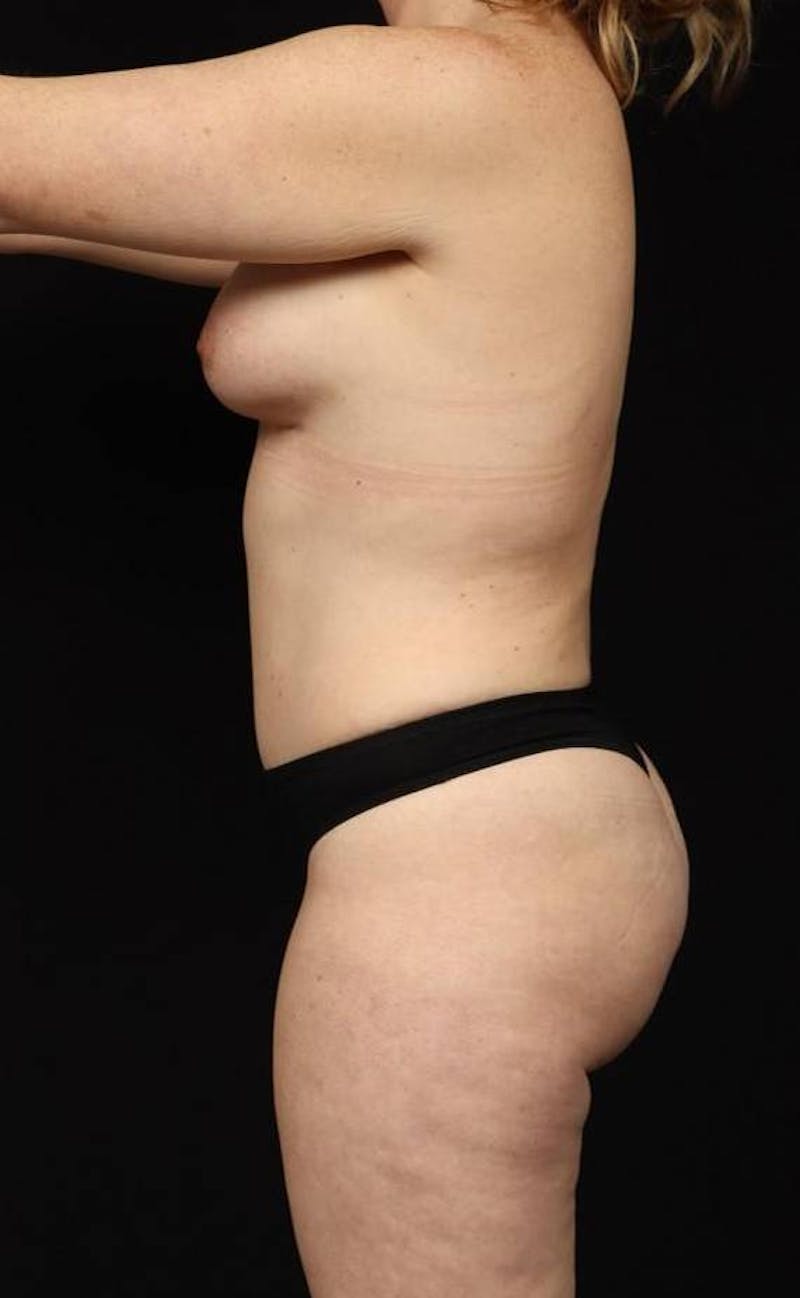 Abdominoplasty Before & After Gallery - Patient 230543 - Image 6