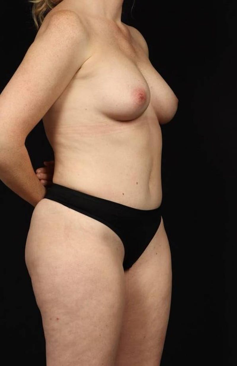 Abdominoplasty Before & After Gallery - Patient 230543 - Image 8
