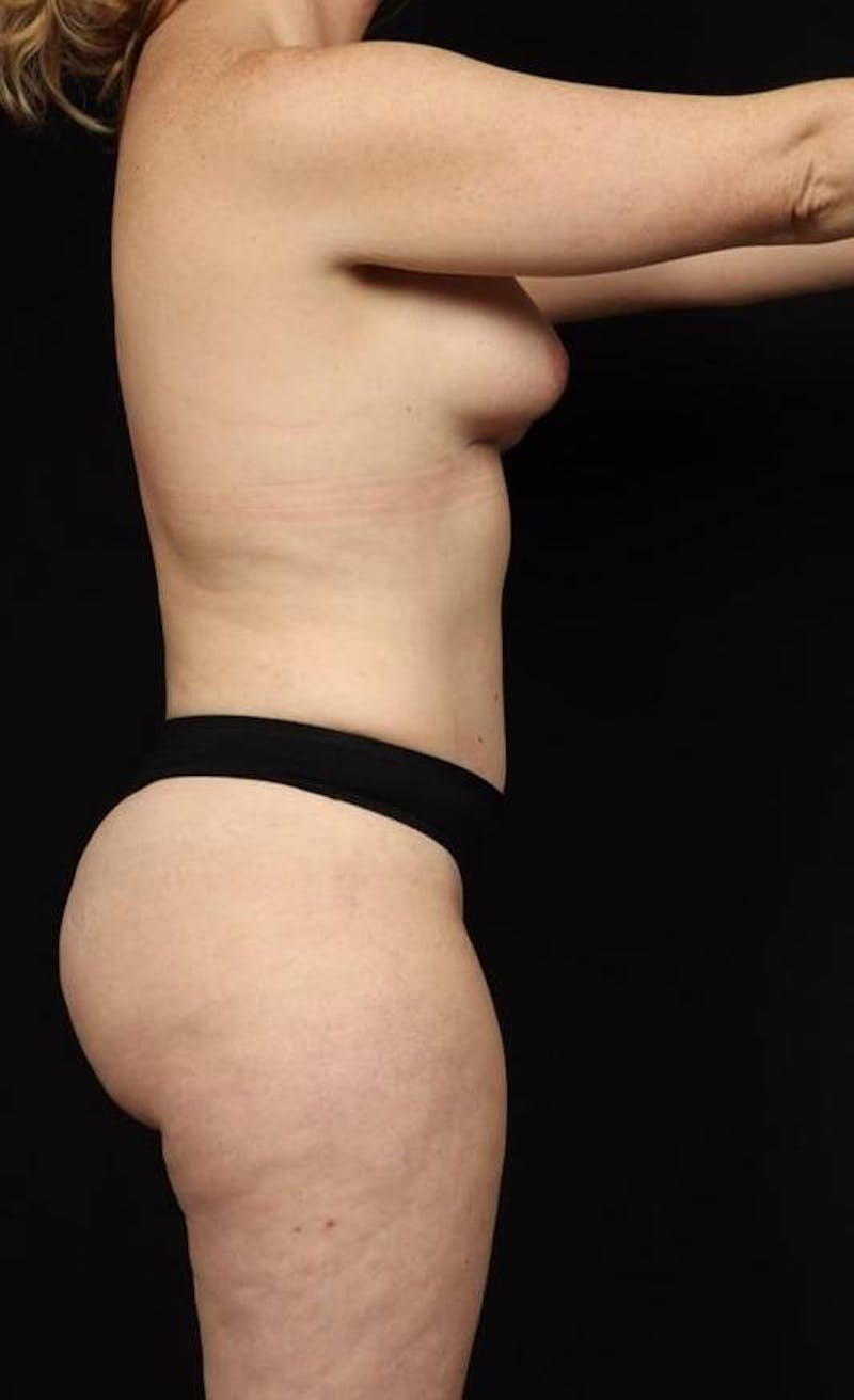Abdominoplasty Before & After Gallery - Patient 230543 - Image 10