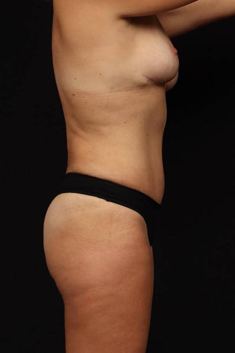 Abdominoplasty Before & After Gallery - Patient 109989 - Image 10