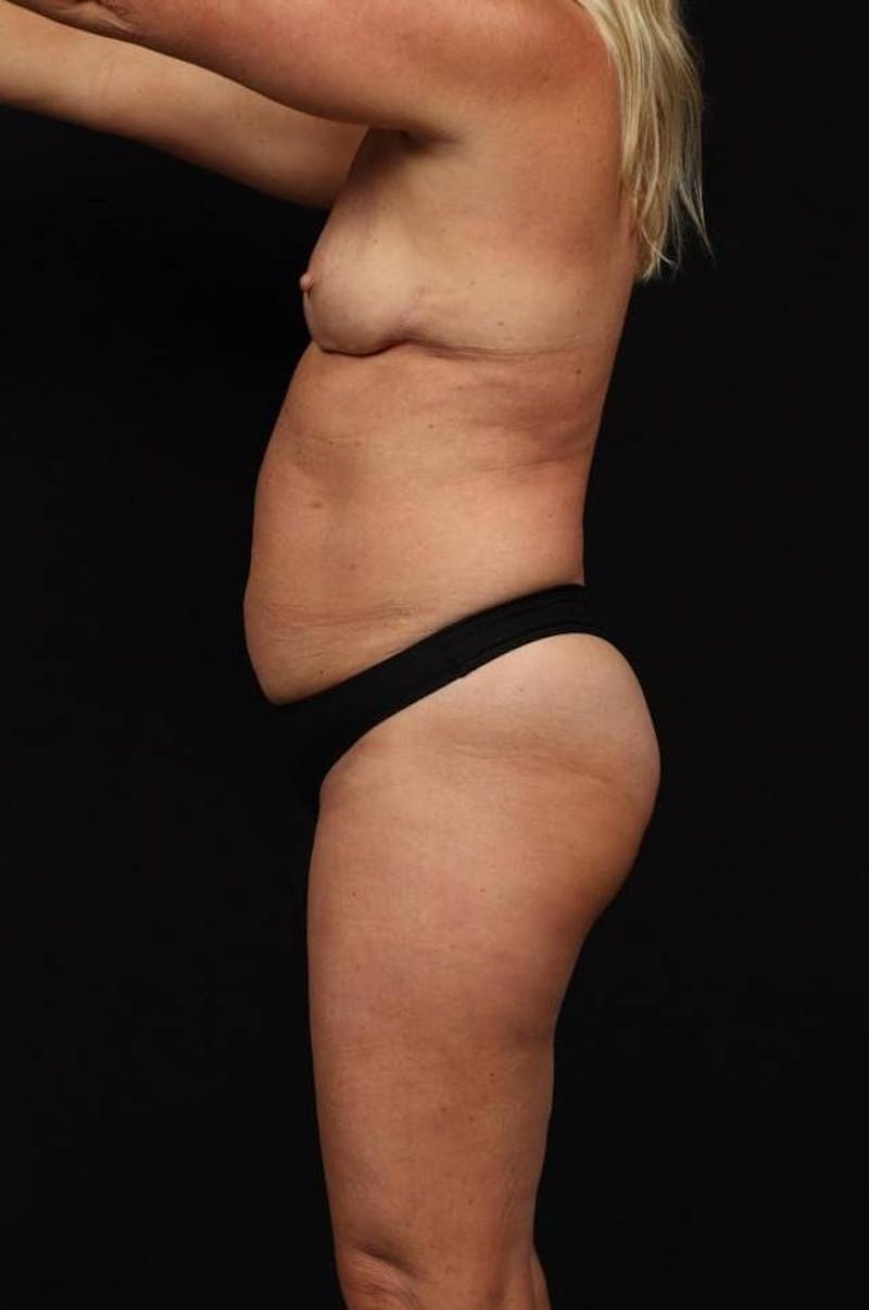 Abdominoplasty Before & After Gallery - Patient 265491 - Image 5