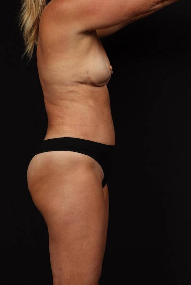 Abdominoplasty Before & After Gallery - Patient 265491 - Image 10