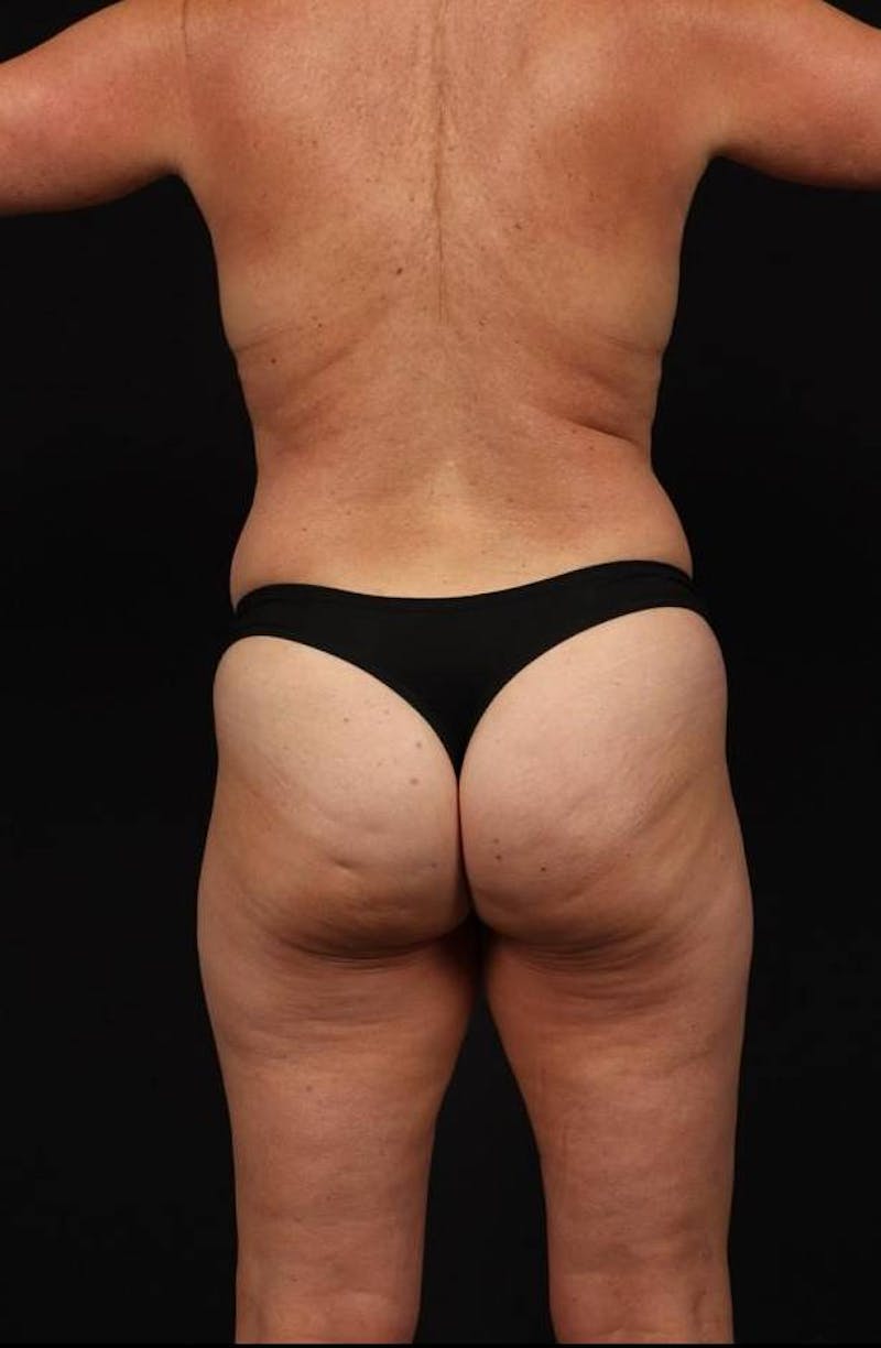 Abdominoplasty Before & After Gallery - Patient 265491 - Image 11