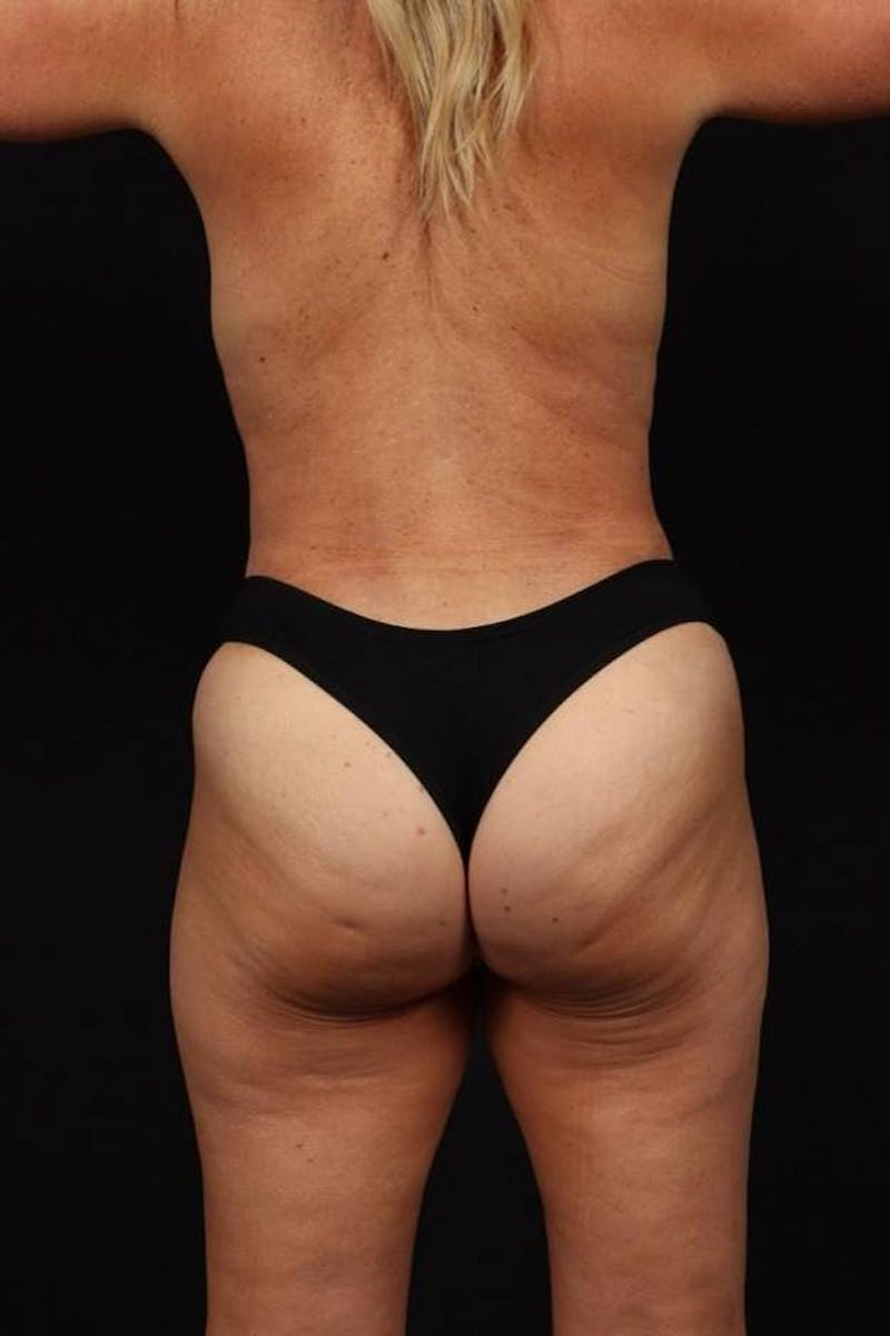 Abdominoplasty Before & After Gallery - Patient 265491 - Image 12