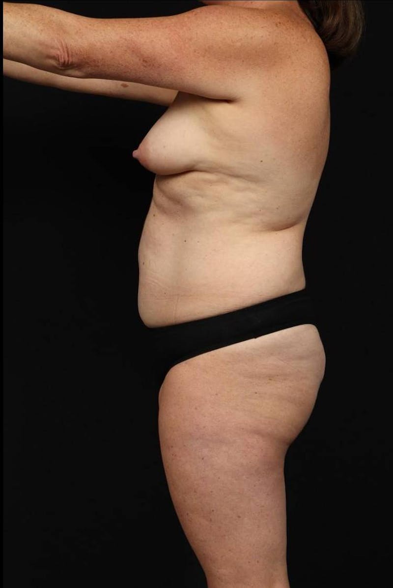 Abdominoplasty Before & After Gallery - Patient 233203 - Image 5