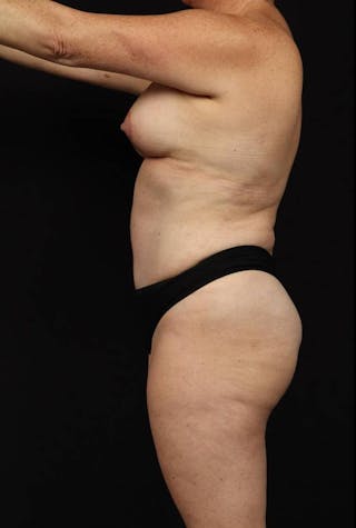 Abdominoplasty Before & After Gallery - Patient 233203 - Image 6