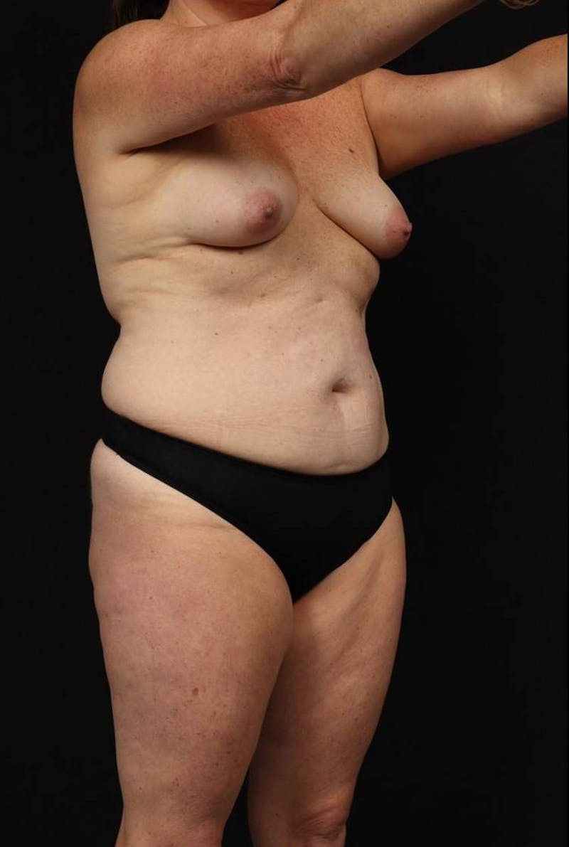 Abdominoplasty Before & After Gallery - Patient 233203 - Image 7