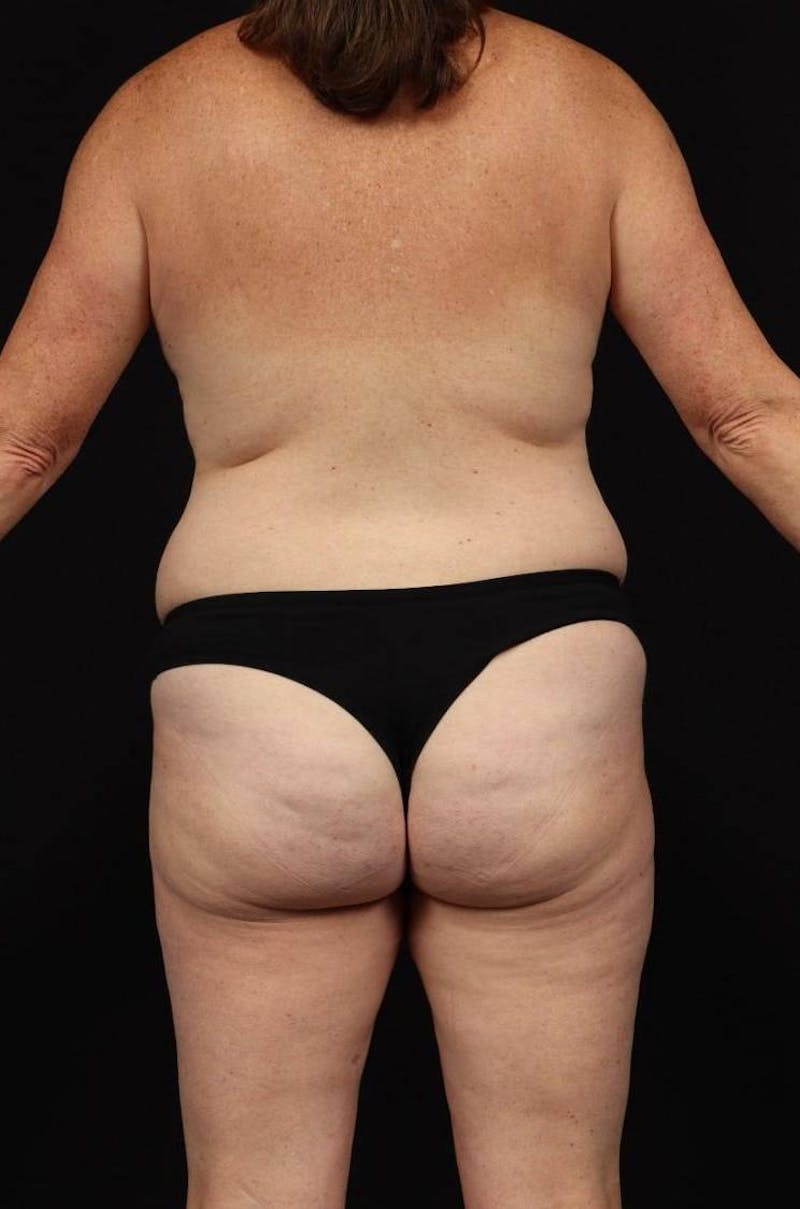 Abdominoplasty Before & After Gallery - Patient 233203 - Image 11