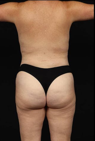 Abdominoplasty Before & After Gallery - Patient 233203 - Image 12