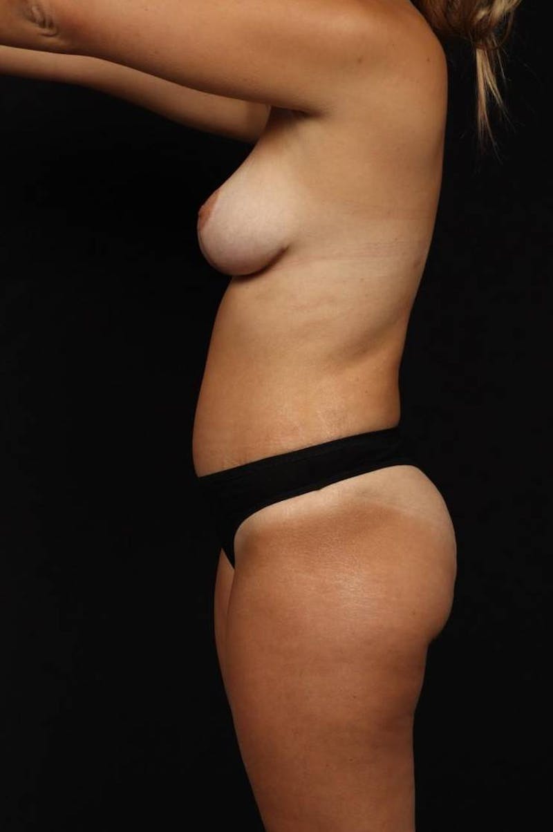 Abdominoplasty Before & After Gallery - Patient 333879 - Image 6