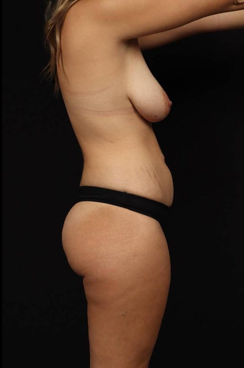 Abdominoplasty Before & After Gallery - Patient 333879 - Image 9