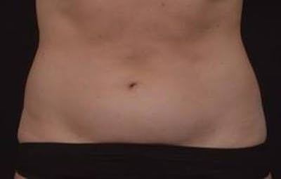 Abdominoplasty Before & After Gallery - Patient 271915 - Image 1