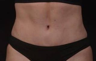 Abdominoplasty Before & After Gallery - Patient 271915 - Image 2