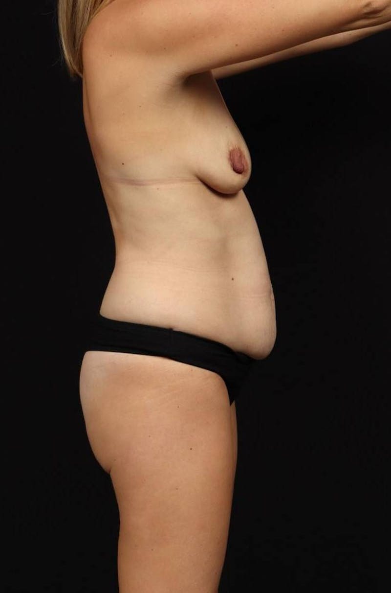 Abdominoplasty Before & After Gallery - Patient 134807 - Image 9