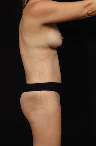 Abdominoplasty Before & After Gallery - Patient 132658 - Image 10