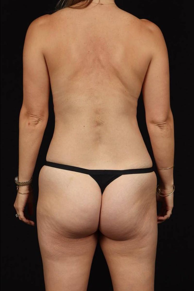 Abdominoplasty Before & After Gallery - Patient 132658 - Image 11