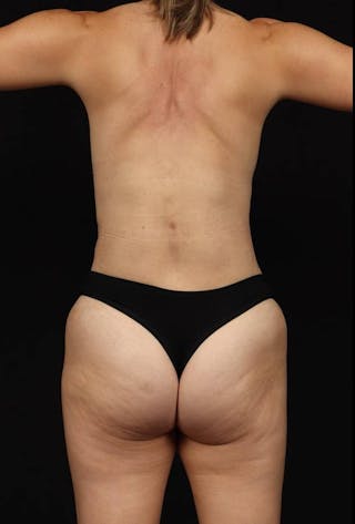Abdominoplasty Before & After Gallery - Patient 132658 - Image 12