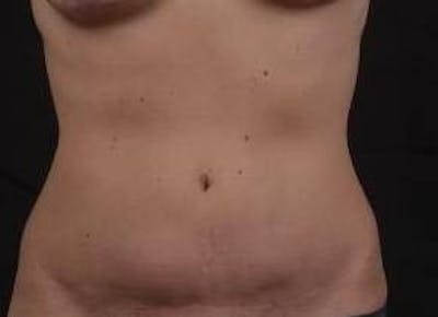 Abdominoplasty Before & After Gallery - Patient 269362 - Image 1