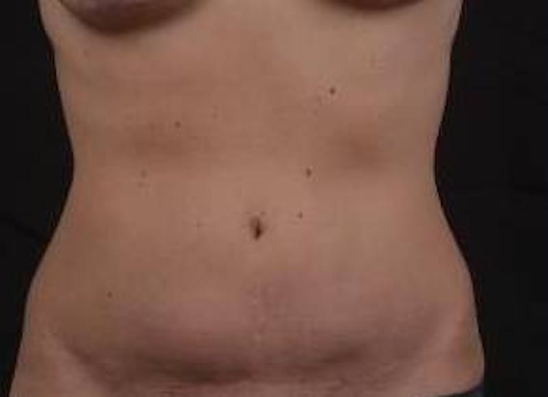 Abdominoplasty Before & After Gallery - Patient 269362 - Image 1