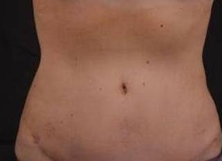 Abdominoplasty Before & After Gallery - Patient 269362 - Image 2