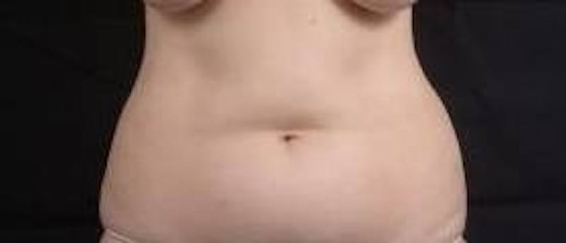 Abdominoplasty Before & After Gallery - Patient 137865 - Image 1