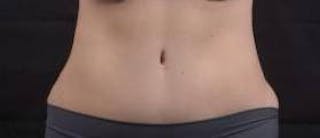 Abdominoplasty Before & After Gallery - Patient 137865 - Image 2