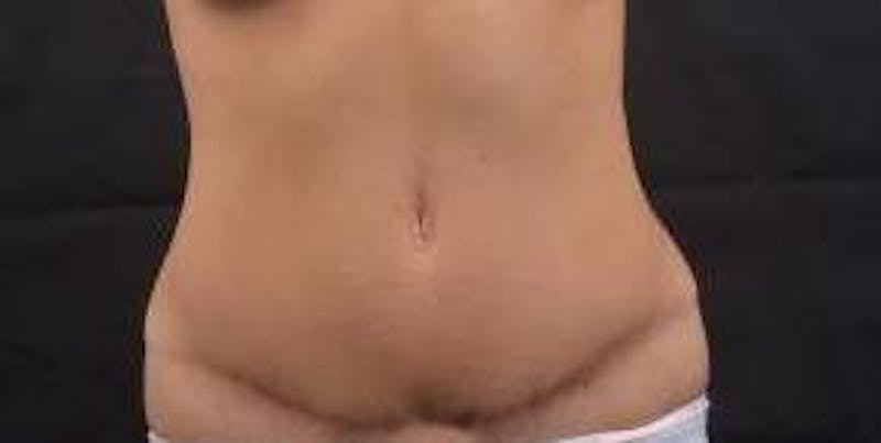 Abdominoplasty Before & After Gallery - Patient 170814 - Image 1