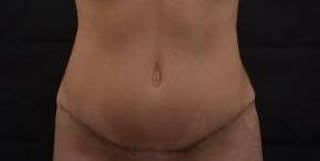 Abdominoplasty Before & After Gallery - Patient 170814 - Image 2
