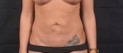 Abdominoplasty Before & After Gallery - Patient 372804 - Image 1