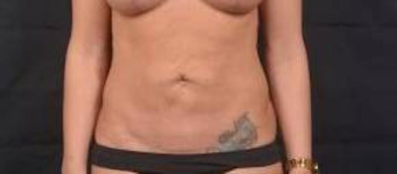 Abdominoplasty Before & After Gallery - Patient 372804 - Image 1