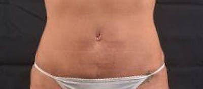 Abdominoplasty Before & After Gallery - Patient 372804 - Image 2