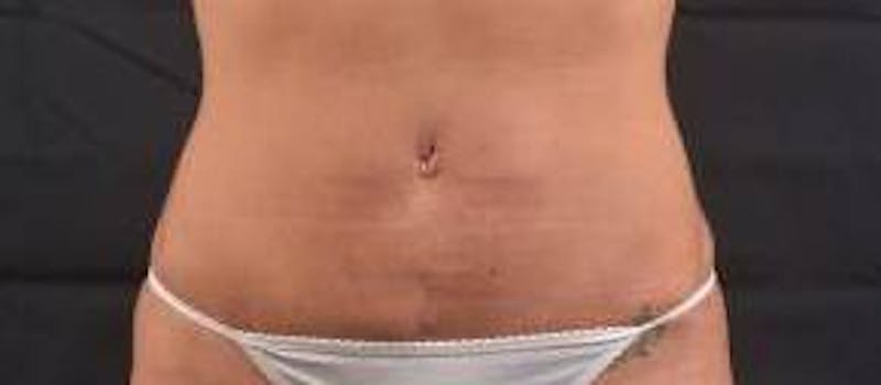 Abdominoplasty Before & After Gallery - Patient 372804 - Image 2