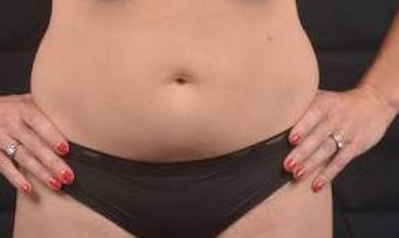 Abdominoplasty Before & After Gallery - Patient 436118 - Image 1