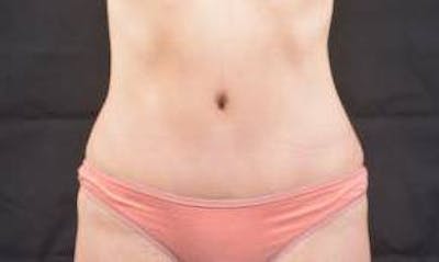 Abdominoplasty Before & After Gallery - Patient 436118 - Image 2