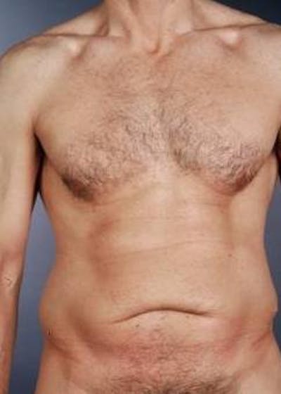 360 Liposuction Before & After Gallery - Patient 296205 - Image 1