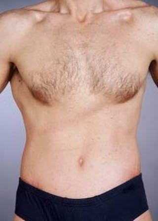 Abdominoplasty Before & After Gallery - Patient 330225 - Image 2