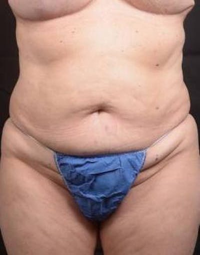 Abdominoplasty Before & After Gallery - Patient 296367 - Image 1