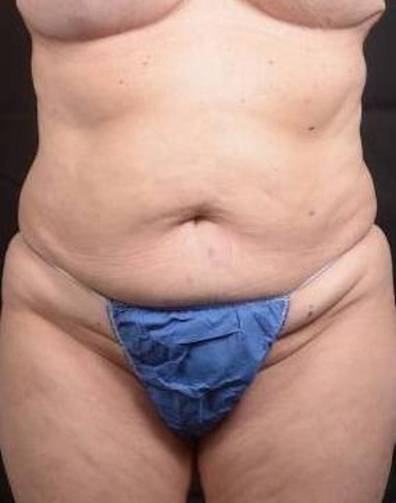 Abdominoplasty Before & After Gallery - Patient 296367 - Image 1