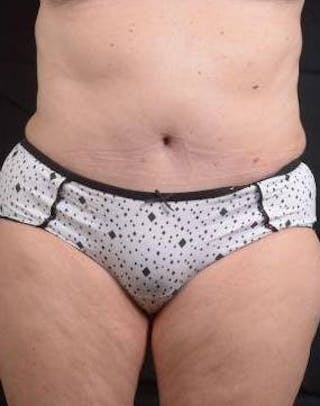 Abdominoplasty Before & After Gallery - Patient 296367 - Image 2
