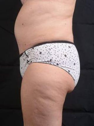 Abdominoplasty Before & After Gallery - Patient 296367 - Image 4