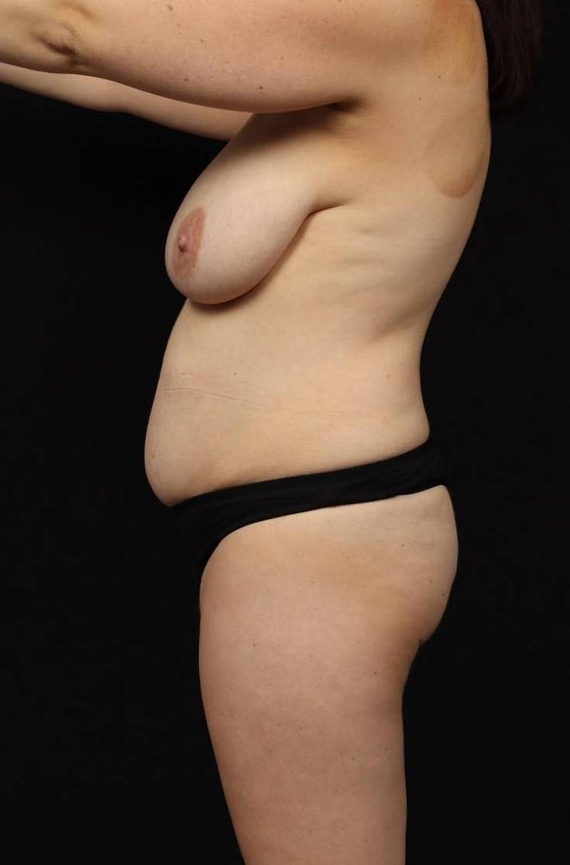 Abdominoplasty Before & After Gallery - Patient 382876 - Image 5