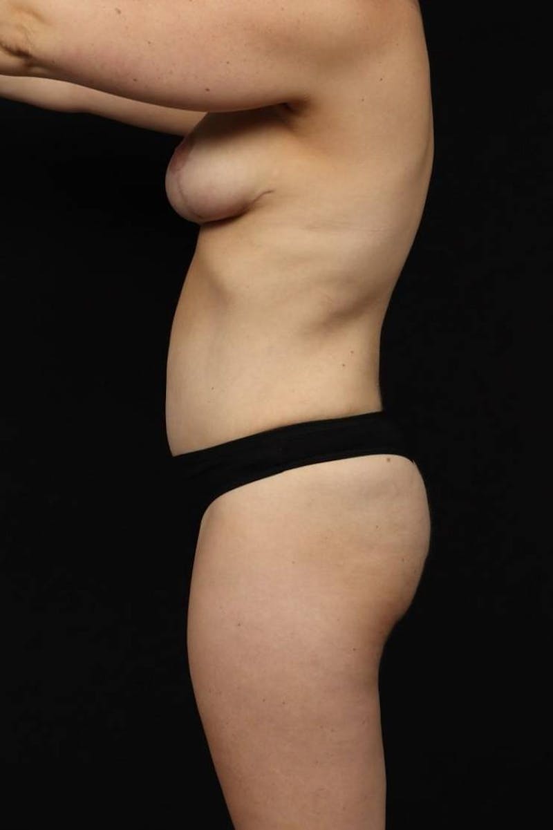 Abdominoplasty Before & After Gallery - Patient 382876 - Image 6