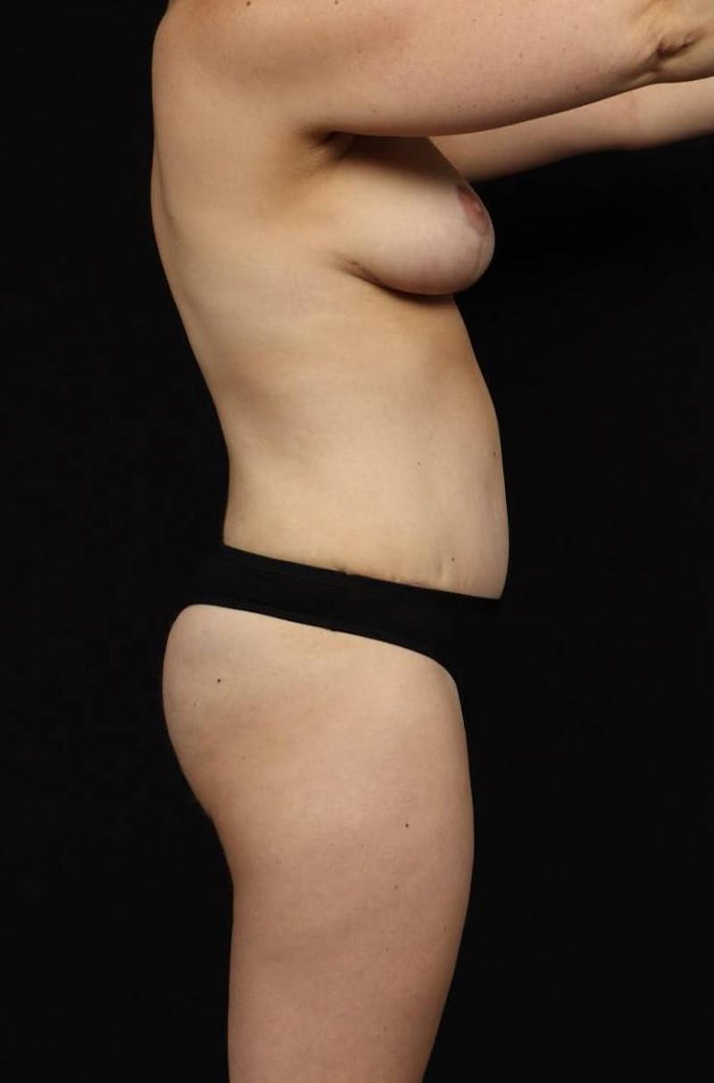 Abdominoplasty Before & After Gallery - Patient 382876 - Image 10