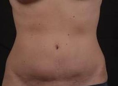 Abdominoplasty Before & After Gallery - Patient 126687 - Image 1