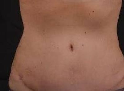 Abdominoplasty Before & After Gallery - Patient 126687 - Image 2