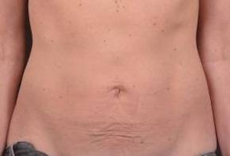 Abdominoplasty Before & After Gallery - Patient 393770 - Image 1