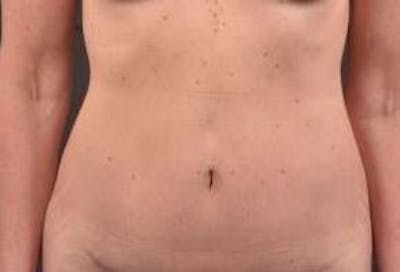Abdominoplasty Before & After Gallery - Patient 393770 - Image 2
