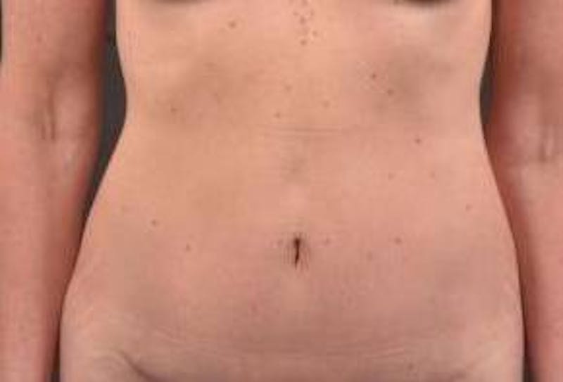 Abdominoplasty Before & After Gallery - Patient 393770 - Image 2
