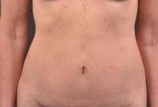 Abdominoplasty Before & After Gallery - Patient 393770 - Image 2