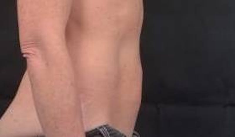 Abdominoplasty Before & After Gallery - Patient 393770 - Image 3